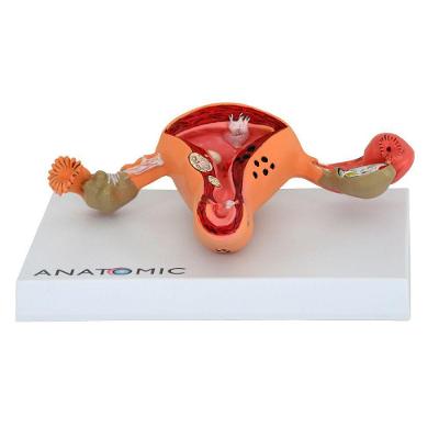 Útero Comtrompas Patológico Em Prancha, Anatomia