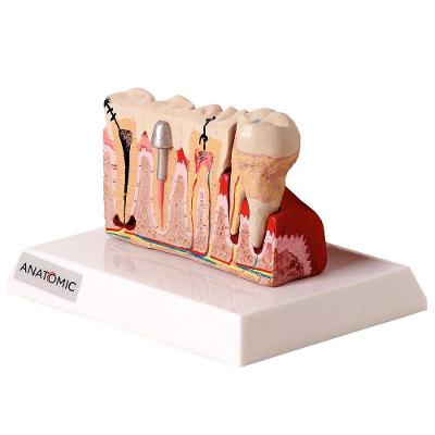 Patologia Dentária e Placa Explicativa em 2 Partes Modelo